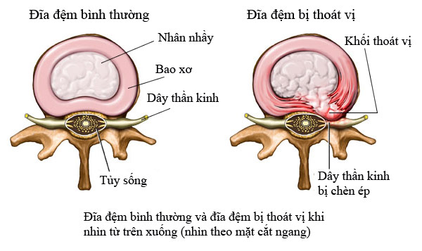 thoát vị đĩa đệm là bệnh gì